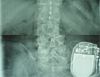 腰痛に対する脊髄硬膜外刺激療法(SCS)