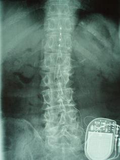腹部に埋め込んだ刺激装置を写したレントゲン写真